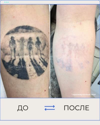 Удаление татуировки
